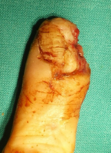 Lesione da schiacciamento del 2°raggio, mano sinistra, con frattura esposta e perdita di sostanza ungueale e pulpare