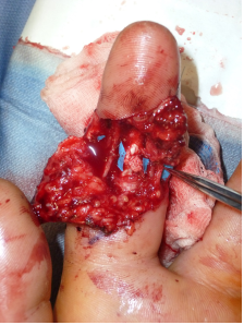 Ricostruzione microchirurgia delle arterie e dei nervi digitali e rivascolarizzazione dell’apice digitale.